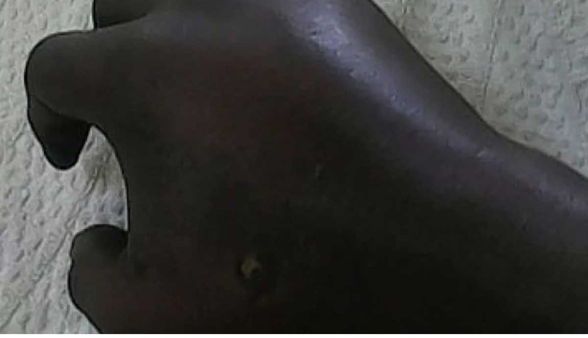 Une Haitienne amputée de son avant-bras en République Dominicaine par son ex petit ami
