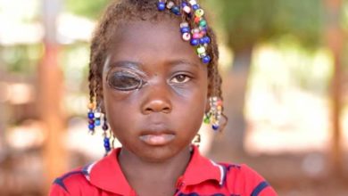 Youvencia, 6 ans, atteinte de la maladie du charbon, risque de perdre son œil droit