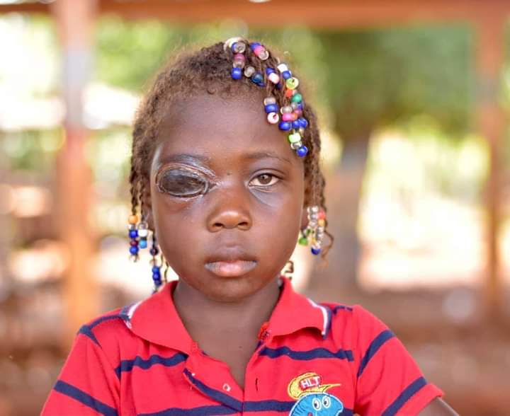 Youvencia, 6 ans, atteinte de la maladie du charbon, risque de perdre son œil droit Youvencia, 6 ans, atteinte de la maladie du charbon, risque de perdre son œil droit