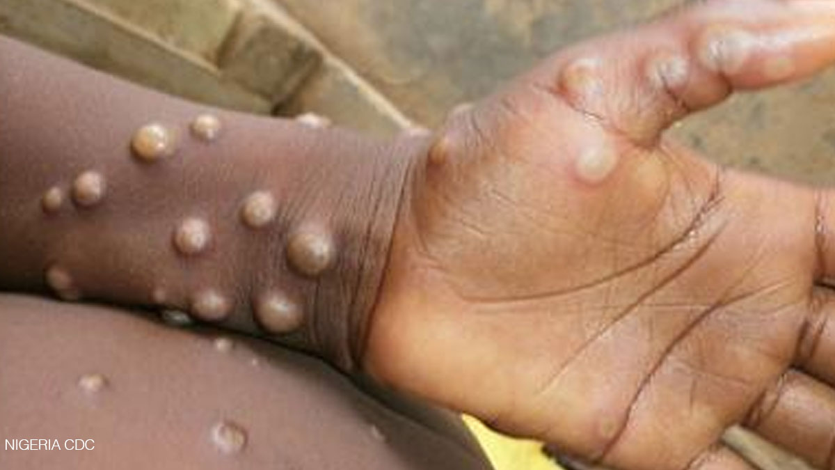Un cas de variole du singe suspecté en Haïti!