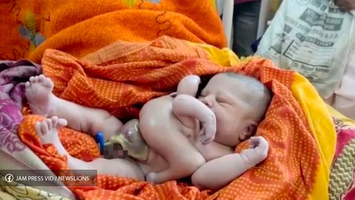 Inde : Un bébé né avec 4 bras et 4 jambes a valu une célébration pour sa ressemblance avec une déesse