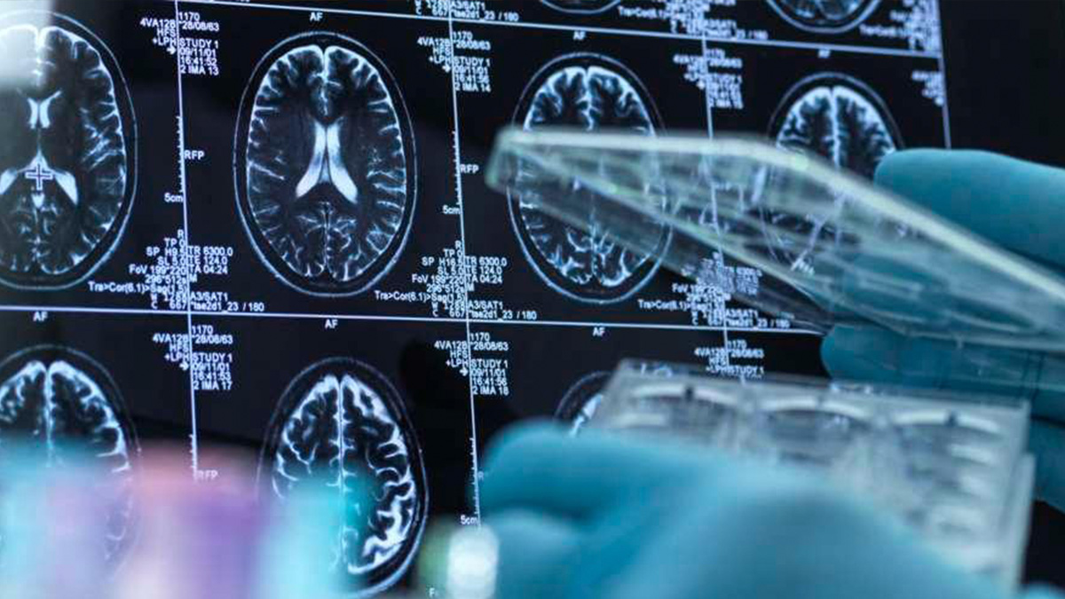 Un essai clinique ouvre la porte à un nouveau médicament contre l'Alzheimer aux États-Unis
